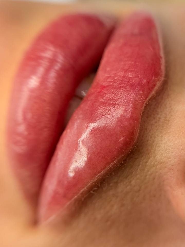 Primer plano del resultado de un aumento de labios en Albeniz Atondo, Valencia Centro