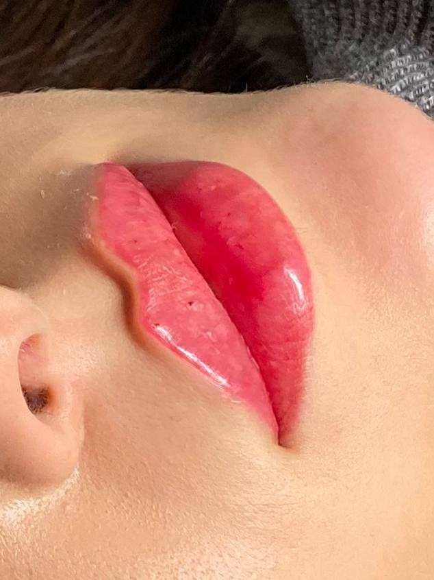 Aumento de labios con ácido hialurónico visto de perfil — Albeniz Atondo Valencia