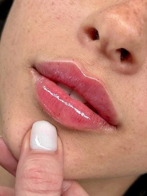 Resultado natural de un aumento de labios — Albeniz Atondo, Valencia Centro